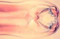 hookworms